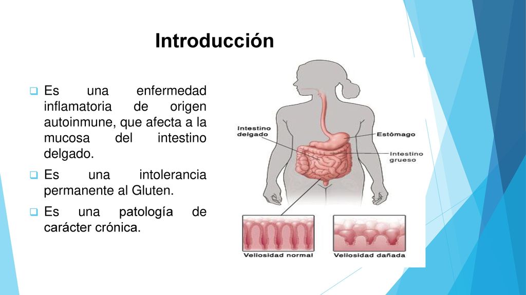 Introducción Es una enfermedad inflamatoria de origen autoinmune, que afecta a la mucosa del intestino delgado.