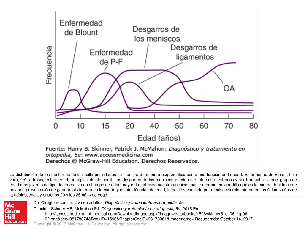 La distribución de los trastornos de la rodilla por edades se muestra de manera esquemática como una función de la edad. Enfermedad de Blount, tibia vara, OA, artrosis; enfermedad, artralgia rotulofemoral. Los desgarros de los meniscos pueden ser internos o externos y ser traumáticos en el grupo de edad más joven o de tipo degenerativo en el grupo de edad mayor. La artrosis muestra un inicio más temprano en la rodilla que en la cadera debido a que hay una presentación de gonartrosis interna en la cuarta y quinta décadas de edad, la cual es causada por meniscectomía interna en los últimos años de la adolescencia y entre los 20 y los 25 años de edad.