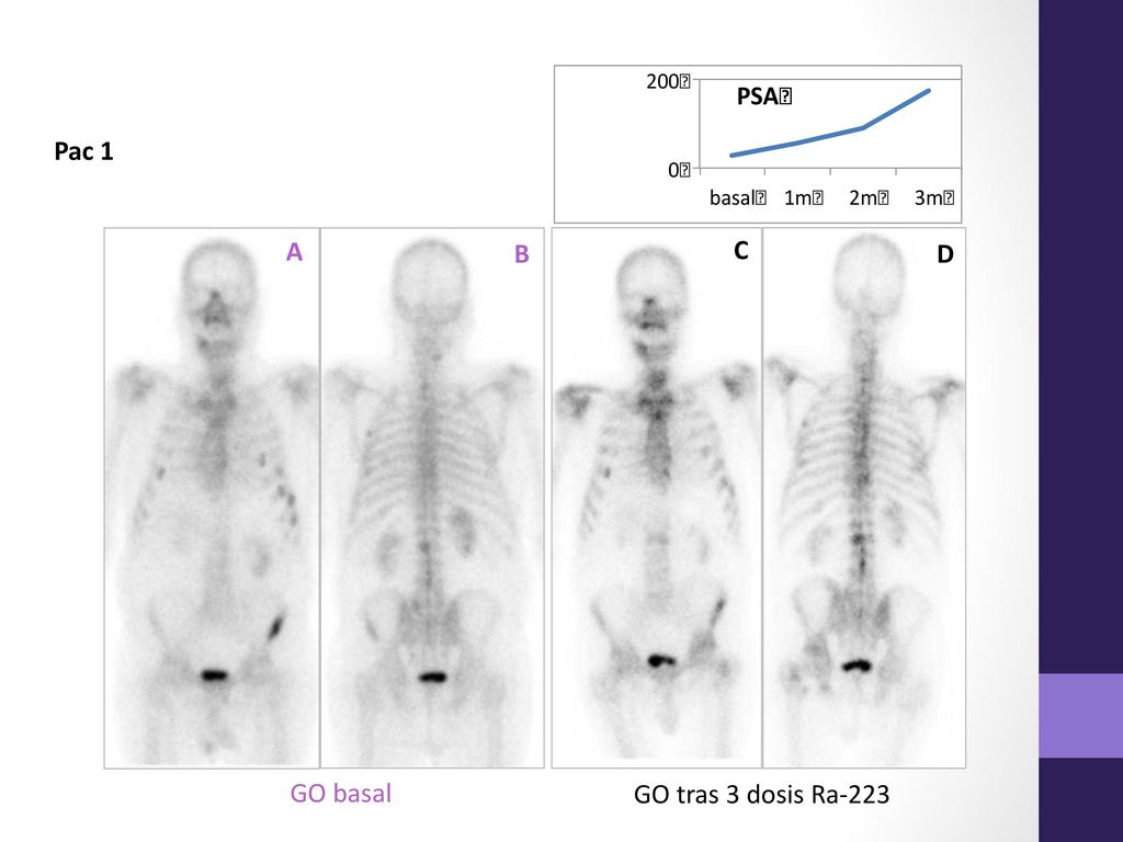 Pac 1 A B C D GO tras 3 dosis Ra-223 GO basal