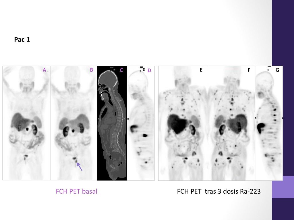Pac 1 A B C D E F G FCH PET tras 3 dosis Ra-223 FCH PET basal
