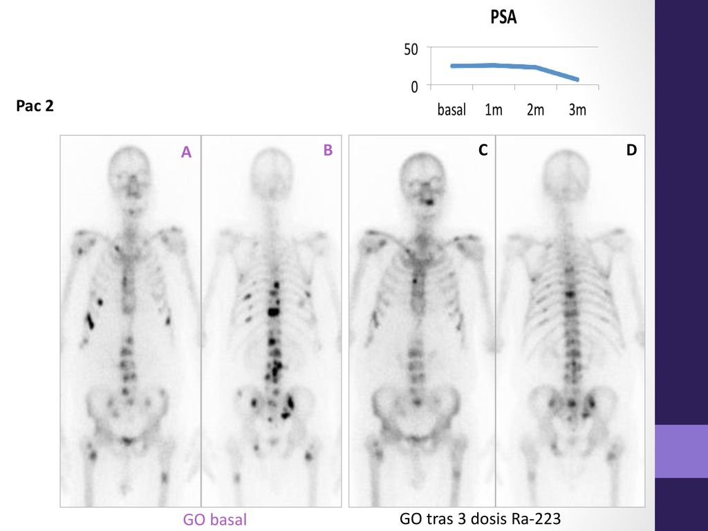 Pac 2 A B C D GO tras 3 dosis Ra-223 GO basal