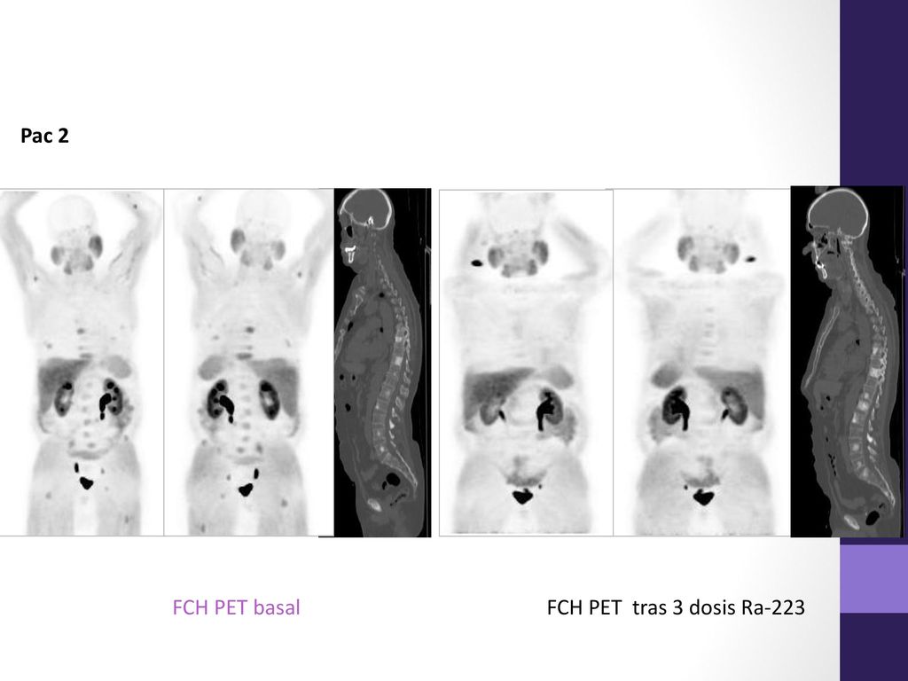 Pac 2 FCH PET tras 3 dosis Ra-223 FCH PET basal