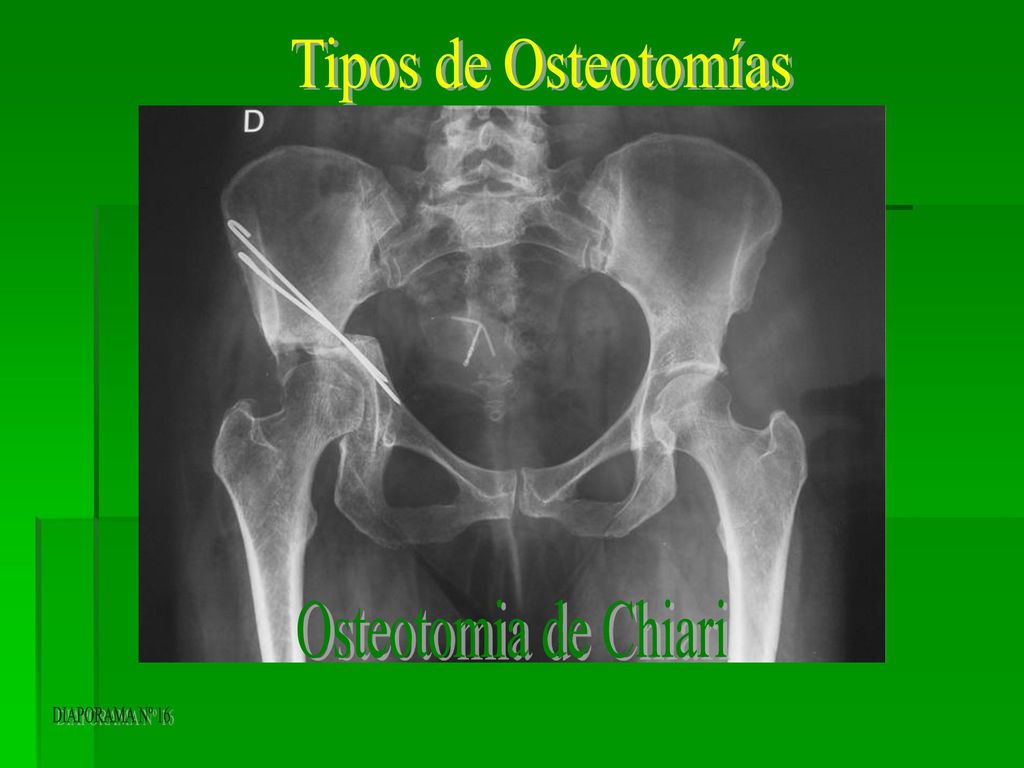Tipos de Osteotomías Osteotomia de Chiari DIAPORAMA Nº 16