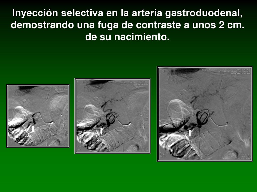 Inyección selectiva en la arteria gastroduodenal, demostrando una fuga de contraste a unos 2 cm.