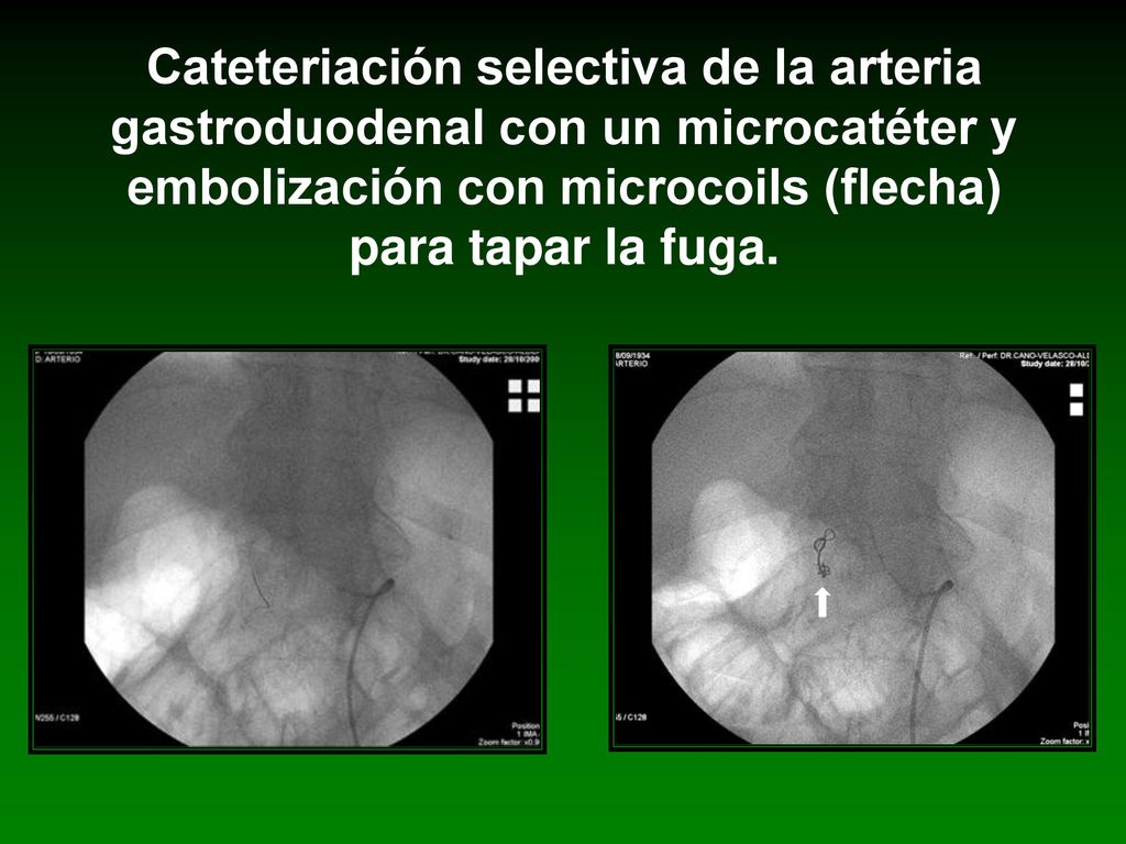 Cateteriación selectiva de la arteria gastroduodenal con un microcatéter y embolización con microcoils (flecha) para tapar la fuga.