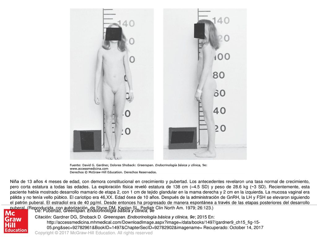 Niña de 13 años 4 meses de edad, con demora constitucional en crecimiento y pubertad. Los antecedentes revelaron una tasa normal de crecimiento, pero corta estatura a todas las edades. La exploración física reveló estatura de 138 cm (–4.5 SD) y peso de 28.6 kg (−3 SD). Recientemente, esta paciente había mostrado desarrollo mamario de etapa 2, con 1 cm de tejido glandular en la mama derecha y 2 cm en la izquierda. La mucosa vaginal era pálida y no tenía vello púbico. El cariotipo era 46,XX. Edad ósea de 10 años. Después de la administración de GnRH, la LH y FSH se elevaron siguiendo el patrón puberal. El estradiol era de 40 pg/ml. Desde entonces ha progresado de manera espontánea a través de las etapas posteriores del desarrollo puberal. (Reproducida, con autorización, de Styne DM, Kaplan SL. Pediatr Clin North Am. 1979; 26:123.)