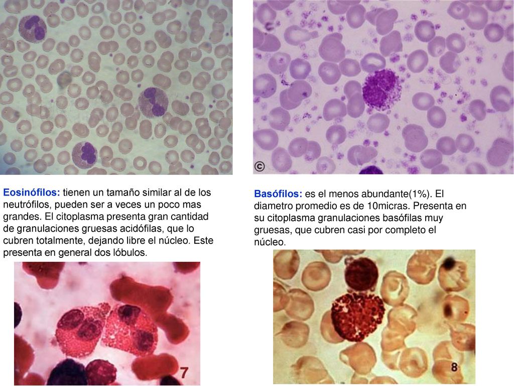 Eosinófilos: tienen un tamaño similar al de los neutrófilos, pueden ser a veces un poco mas grandes. El citoplasma presenta gran cantidad de granulaciones gruesas acidófilas, que lo cubren totalmente, dejando libre el núcleo. Este presenta en general dos lóbulos.