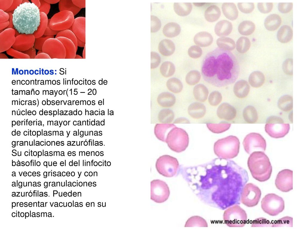 Monocitos: Si encontramos linfocitos de tamaño mayor(15 – 20 micras) observaremos el núcleo desplazado hacia la periferia, mayor cantidad de citoplasma y algunas granulaciones azurófilas.