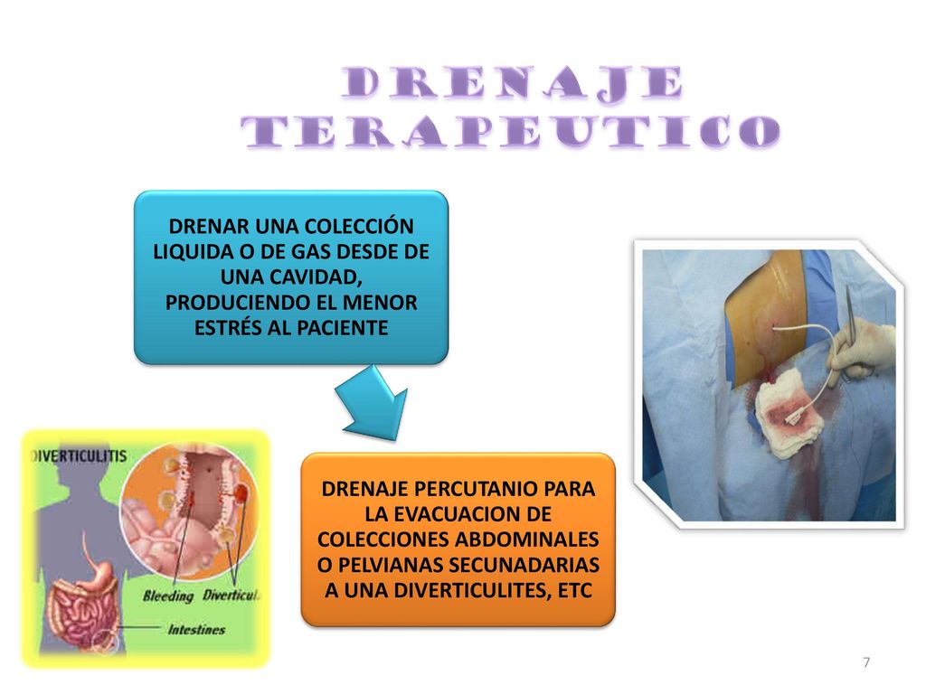 DRENAJE TERAPEUTICO DRENAR UNA COLECCIÓN LIQUIDA O DE GAS DESDE DE UNA CAVIDAD, PRODUCIENDO EL MENOR ESTRÉS AL PACIENTE.