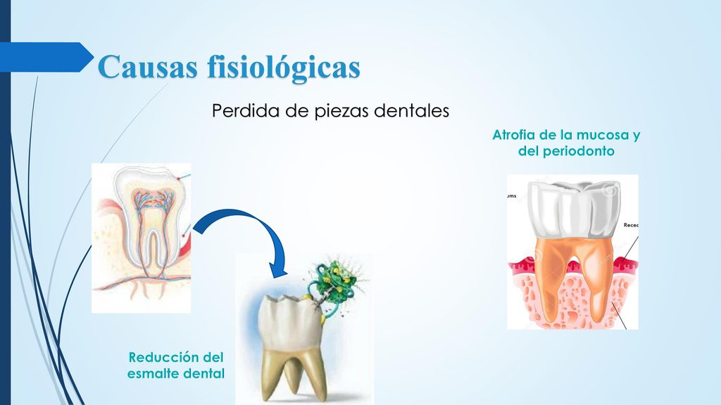 Atrofia de la mucosa y del periodonto Reducción del esmalte dental