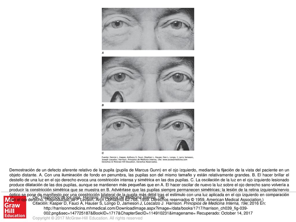 Demostración de un defecto aferente relativo de la pupila (pupila de Marcus Gunn) en el ojo izquierdo, mediante la fijación de la vista del paciente en un objeto distante. A. Con una iluminación de fondo en penumbra, las pupilas son del mismo tamaño y están relativamente grandes. B. El hacer brillar el destello de una luz en el ojo derecho evoca una constricción intensa y simétrica en las dos pupilas. C. La oscilación de la luz en el ojo izquierdo lesionado produce dilatación de las dos pupilas, aunque se mantienen más pequeñas que en A. El hacer oscilar de nuevo la luz sobre el ojo derecho sano volvería a producir la constricción simétrica que se muestra en B. Adviértase que las pupilas siempre permanecen simétricas; la lesión de la retina izquierda/nervio óptico se pone de manifiesto por una constricción bilateral de la pupila más débil tras el estímulo con una luz aplicada en el ojo izquierdo en comparación con el ojo derecho. (Reproducido de P Levatin, Arch Ophtalmol 62:768, Derechos reservados © 1959, American Medical Association.)