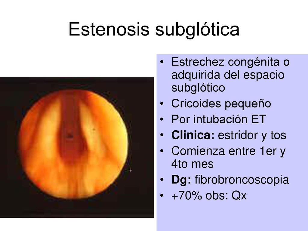 Estenosis subglótica Estrechez congénita o adquirida del espacio subglótico. Cricoides pequeño. Por intubación ET.