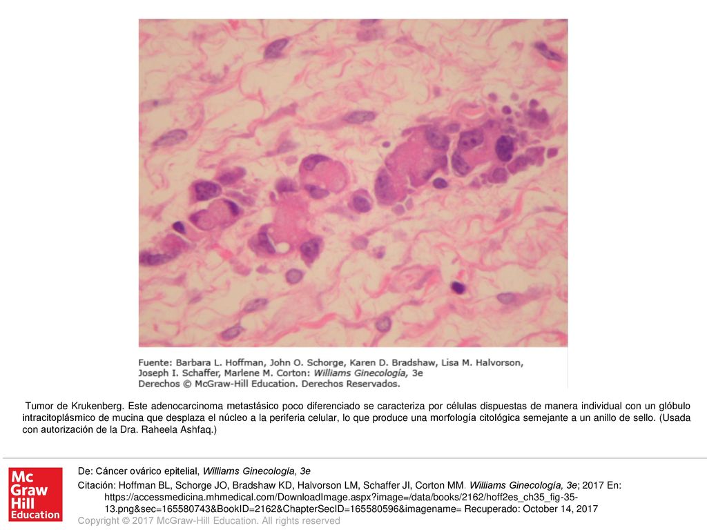 Tumor de Krukenberg. Este adenocarcinoma metastásico poco diferenciado se caracteriza por células dispuestas de manera individual con un glóbulo intracitoplásmico de mucina que desplaza el núcleo a la periferia celular, lo que produce una morfología citológica semejante a un anillo de sello. (Usada con autorización de la Dra. Raheela Ashfaq.)