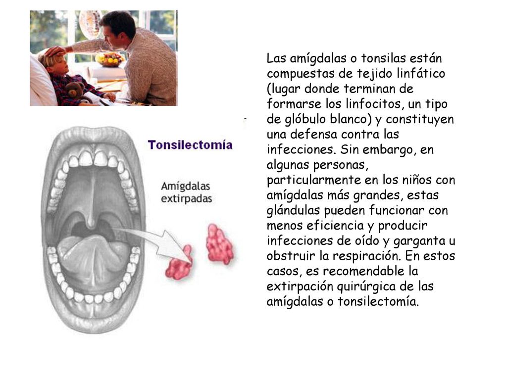 Las amígdalas o tonsilas están compuestas de tejido linfático (lugar donde terminan de formarse los linfocitos, un tipo de glóbulo blanco) y constituyen una defensa contra las infecciones.