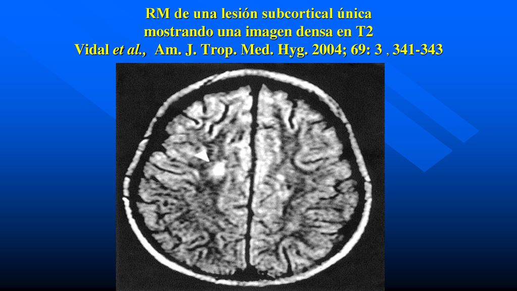 RM de una lesión subcortical única mostrando una imagen densa en T2 Vidal et al., Am.