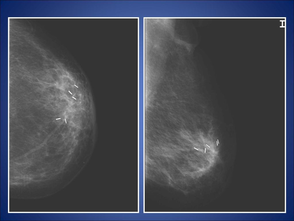1ER CONTROL - ENGROSAMIENTO TRABECULAR. - ENGROSAMIENTO DE LA PIEL Y AREOLA.