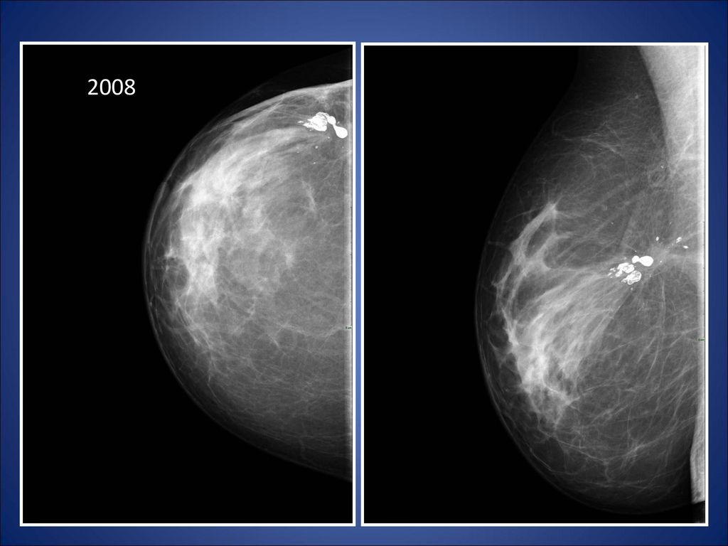 2008 CARCINOMA DUCTAL INFILTRANTE A LOS 36 AÑOS EN Nov. Del 2000