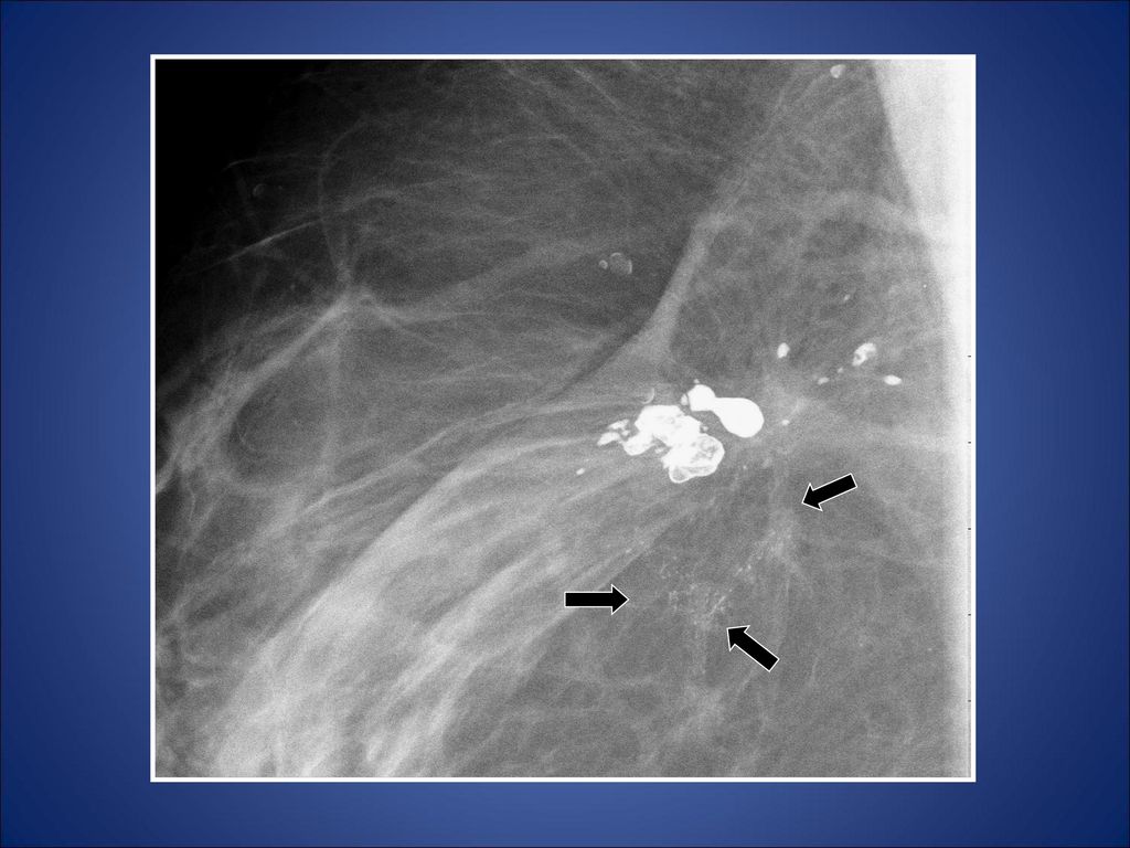 En el ultimo control de 2009 (9 años después) aparecen unas calcificaciones de reciente aparición que tienen morfología lineal intraductal sospechosas de malignidad.