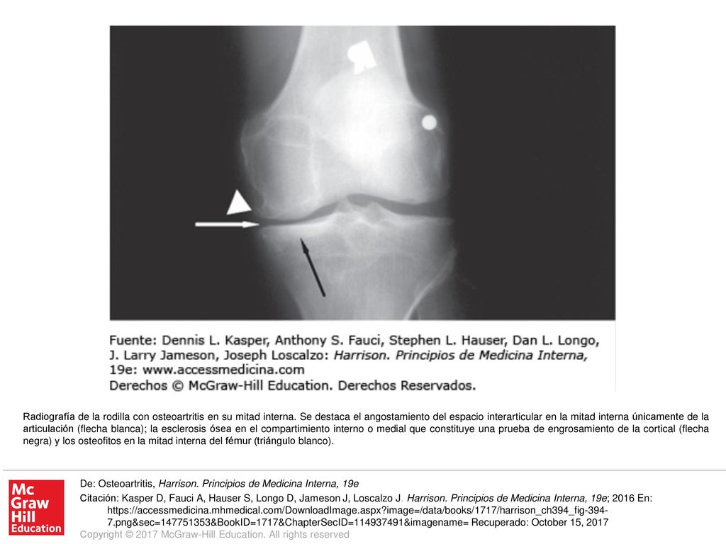 Radiografía de la rodilla con osteoartritis en su mitad interna