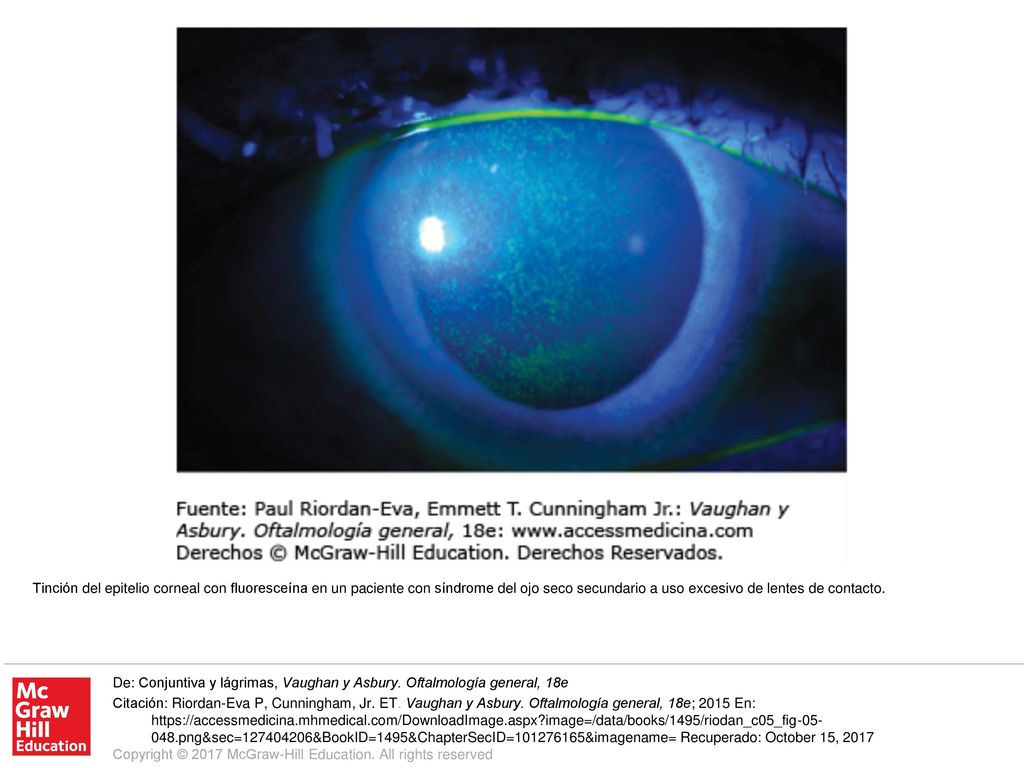 Tinción del epitelio corneal con fluoresceína en un paciente con síndrome del ojo seco secundario a uso excesivo de lentes de contacto.