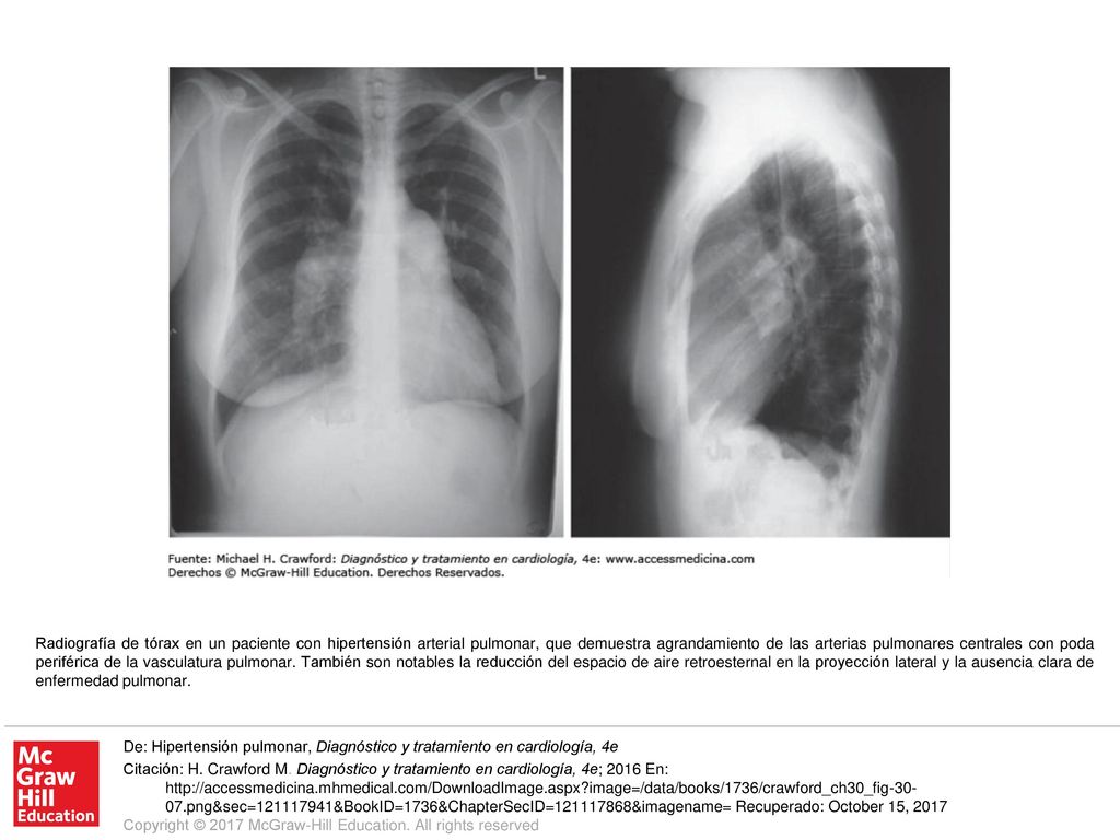 Radiografía de tórax en un paciente con hipertensión arterial pulmonar, que demuestra agrandamiento de las arterias pulmonares centrales con poda periférica de la vasculatura pulmonar. También son notables la reducción del espacio de aire retroesternal en la proyección lateral y la ausencia clara de enfermedad pulmonar.