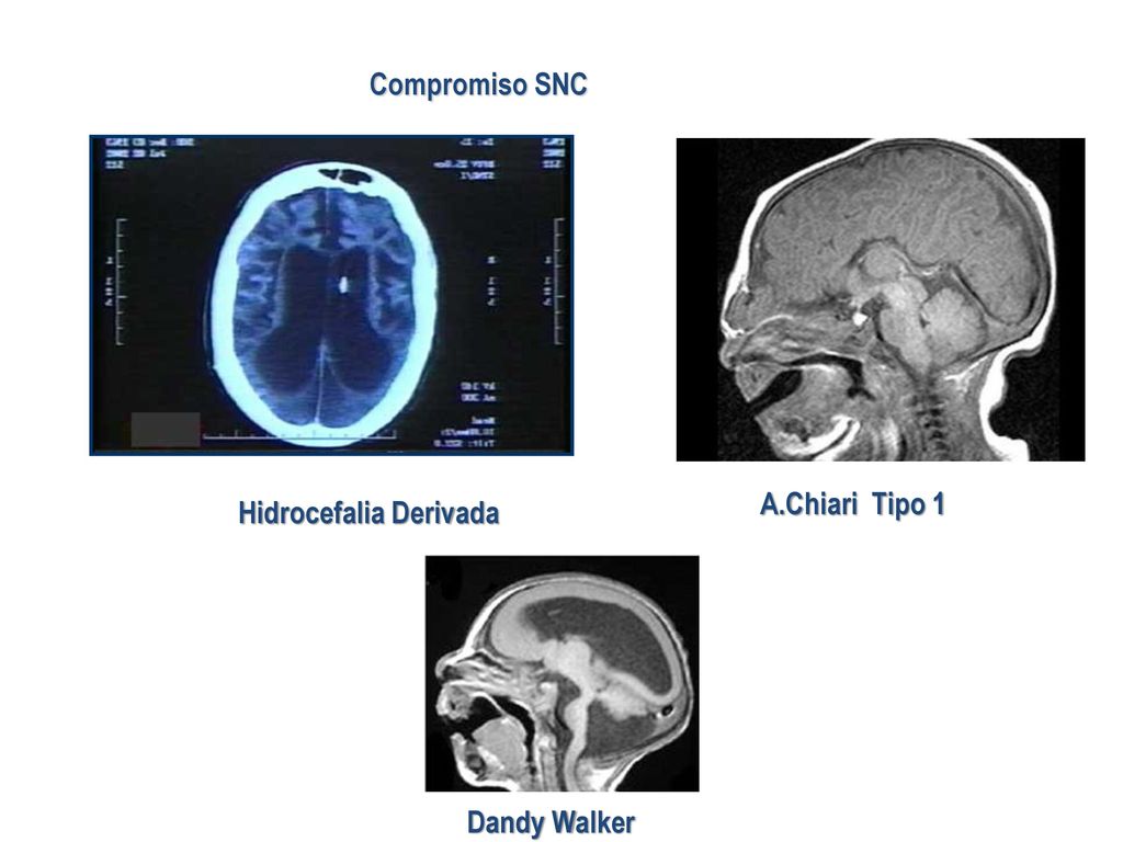Compromiso SNC A.Chiari Tipo 1 Hidrocefalia Derivada Dandy Walker