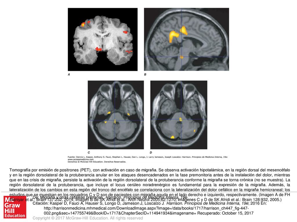 Tomografía por emisión de positrones (PET), con activación en caso de migraña. Se observa activación hipotalámica, en la región dorsal del mesencéfalo y en la región dorsolateral de la protuberancia anular en los ataques desencadenados en la fase premonitoria antes de la instalación del dolor, mientras que en las crisis de migraña, persiste la activación de la región dorsolateral de la protuberancia conforme la migraña se torna crónica (no se muestra). La región dorsolateral de la protuberancia, que incluye el locus cerúleo noradrenérgico es fundamental para la expresión de la migraña. Además, la lateralización de los cambios en esta región del tronco del encéfalo se correlaciona con la lateralización del dolor cefálico en la migraña hemicraneal; los estudios que se muestran en los recuadros C y D son de pacientes con migraña aguda en el lado derecho e izquierdo, respectivamente. (Imagen A de FH Maniyar et al.: Brain 137:232, 2014; imagen B de SK Afridi et al.: Arch Neurol 2005;62:1270; imágenes C y D de SK Afridi et al.: Brain 128:932, 2005.)