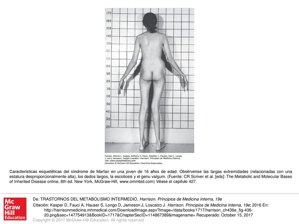 Características esqueléticas del síndrome de Marfan en una joven de 16 años de edad. Obsérvense las largas extremidades (relacionadas con una estatura desproporcionalmente alta), los dedos largos, la escoliosis y el genu valgum. (Fuente: CR Scriver et al. [eds]: The Metabolic and Molecular Bases of Inherited Disease online, 8th ed. New York, McGraw-Hill,   Véase el capítulo 427.