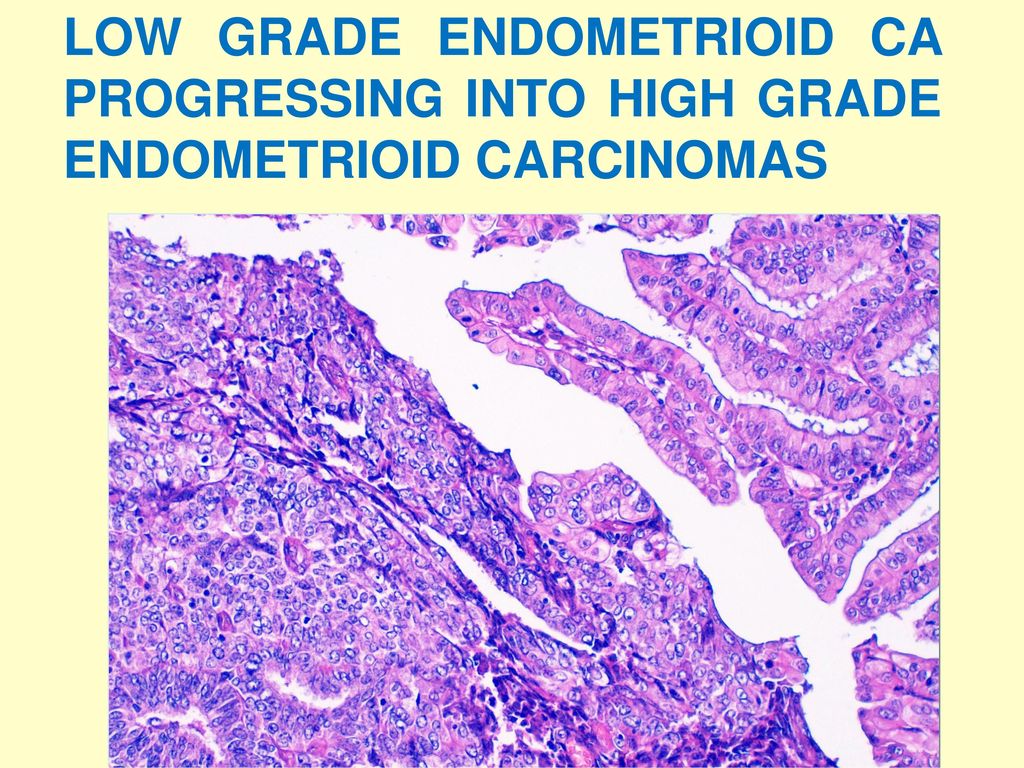 LOW GRADE ENDOMETRIOID CA PROGRESSING INTO HIGH GRADE ENDOMETRIOID CARCINOMAS
