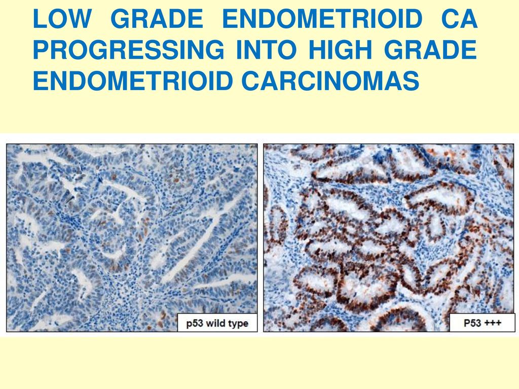 LOW GRADE ENDOMETRIOID CA PROGRESSING INTO HIGH GRADE ENDOMETRIOID CARCINOMAS