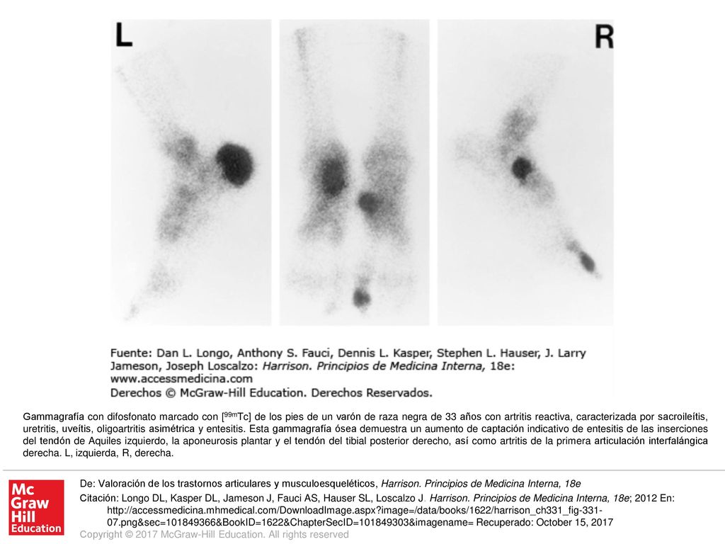 Gammagrafía con difosfonato marcado con [99mTc] de los pies de un varón de raza negra de 33 años con artritis reactiva, caracterizada por sacroileítis, uretritis, uveítis, oligoartritis asimétrica y entesitis. Esta gammagrafía ósea demuestra un aumento de captación indicativo de entesitis de las inserciones del tendón de Aquiles izquierdo, la aponeurosis plantar y el tendón del tibial posterior derecho, así como artritis de la primera articulación interfalángica derecha. L, izquierda, R, derecha.