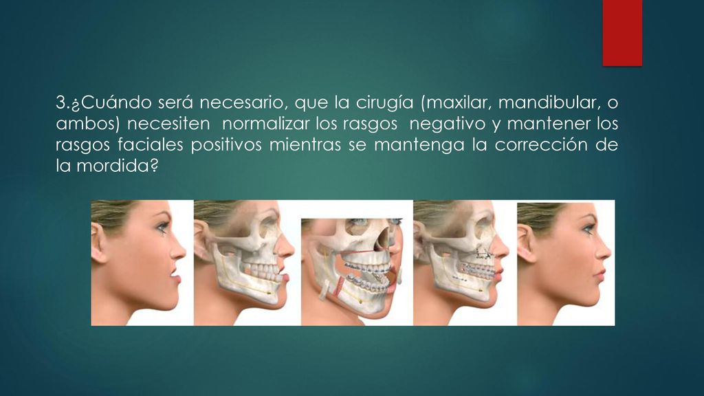 3.¿Cuándo será necesario, que la cirugía (maxilar, mandibular, o ambos) necesiten normalizar los rasgos negativo y mantener los rasgos faciales positivos mientras se mantenga la corrección de la mordida