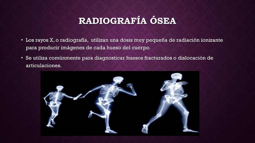 Radiografía ósea Los rayos X, o radiografía, utilizan una dosis muy pequeña de radiación ionizante para producir imágenes de cada hueso del cuerpo.