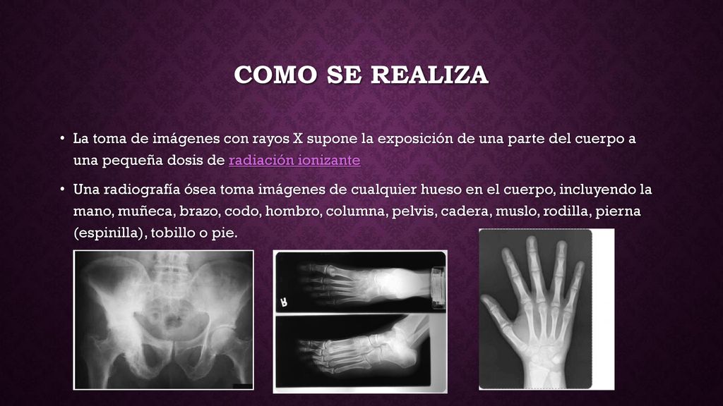Como se realiza La toma de imágenes con rayos X supone la exposición de una parte del cuerpo a una pequeña dosis de radiación ionizante.