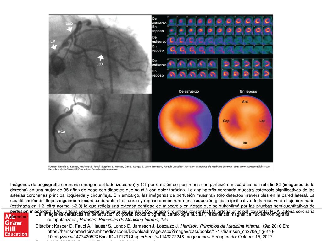 Imágenes de angiografía coronaria (imagen del lado izquierdo) y CT por emisión de positrones con perfusión miocárdica con rubidio-82 (imágenes de la derecha) en una mujer de 85 años de edad con diabetes que acudió con dolor torácico. La angiografía coronaria muestra estenosis significativas de las arterias coronarias principal izquierda y circunfleja. Sin embargo, las imágenes de perfusión muestran sólo defectos irreversibles en la pared lateral. La cuantificación del flujo sanguíneo miocárdico durante el esfuerzo y reposo demostraron una reducción global significativa de la reserva de flujo coronario (estimada en 1.2, cifra normal >2.0) lo que refleja una extensa cantidad de miocardio en riesgo que se subestimó por las pruebas semicuantitativas de perfusión miocárdica. LAD, arteria descendente anterior izquierda; LCX, arteria circunfleja izquierda; LM, arteria principal izquierda; RCA, arteria coronaria derecha.