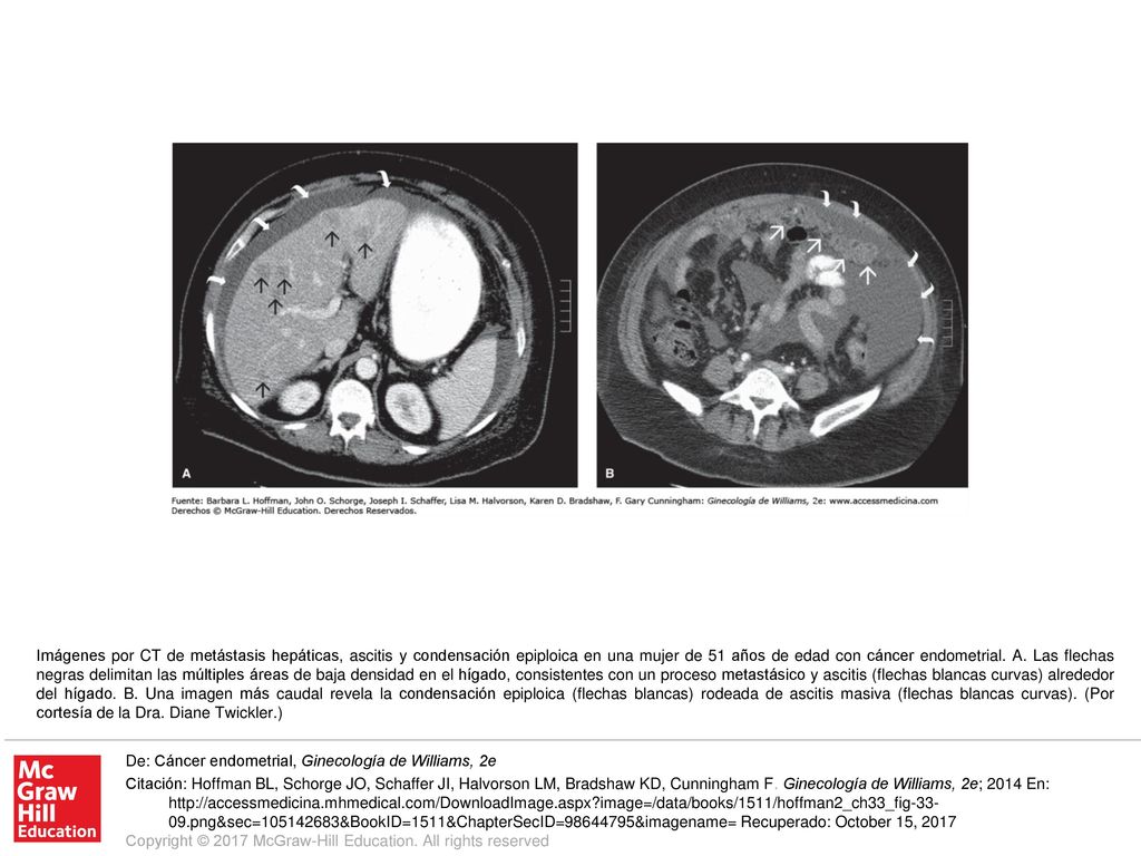 Imágenes por CT de metástasis hepáticas, ascitis y condensación epiploica en una mujer de 51 años de edad con cáncer endometrial. A. Las flechas negras delimitan las múltiples áreas de baja densidad en el hígado, consistentes con un proceso metastásico y ascitis (flechas blancas curvas) alrededor del hígado. B. Una imagen más caudal revela la condensación epiploica (flechas blancas) rodeada de ascitis masiva (flechas blancas curvas). (Por cortesía de la Dra. Diane Twickler.)