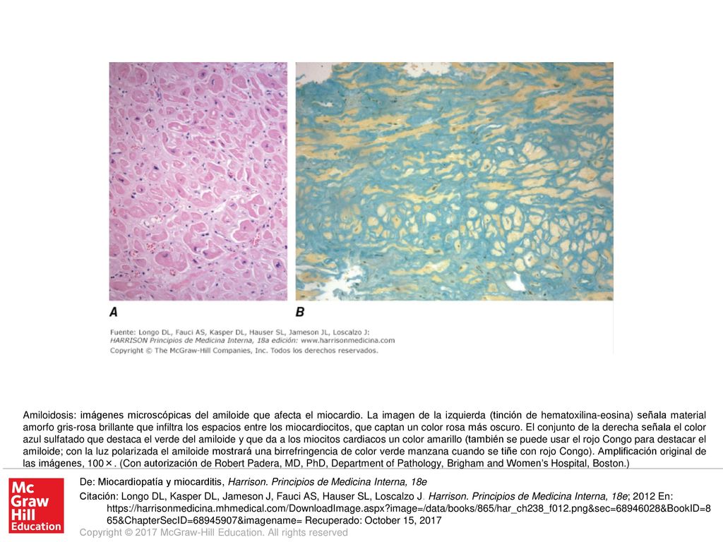Amiloidosis: imágenes microscópicas del amiloide que afecta el miocardio. La imagen de la izquierda (tinción de hematoxilina-eosina) señala material amorfo gris-rosa brillante que infiltra los espacios entre los miocardiocitos, que captan un color rosa más oscuro. El conjunto de la derecha señala el color azul sulfatado que destaca el verde del amiloide y que da a los miocitos cardiacos un color amarillo (también se puede usar el rojo Congo para destacar el amiloide; con la luz polarizada el amiloide mostrará una birrefringencia de color verde manzana cuando se tiñe con rojo Congo). Amplificación original de las imágenes, 100×. (Con autorización de Robert Padera, MD, PhD, Department of Pathology, Brigham and Women’s Hospital, Boston.)