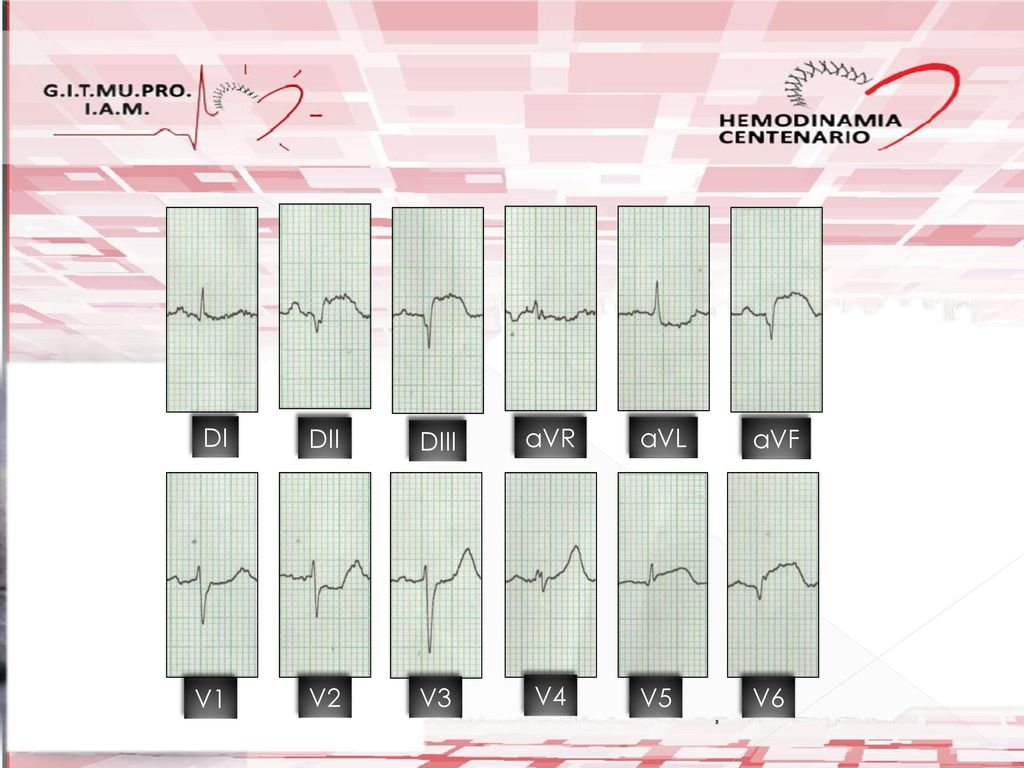 DI DII DIII aVR aVL aVF V1 V2 V3 V4 V5 V6