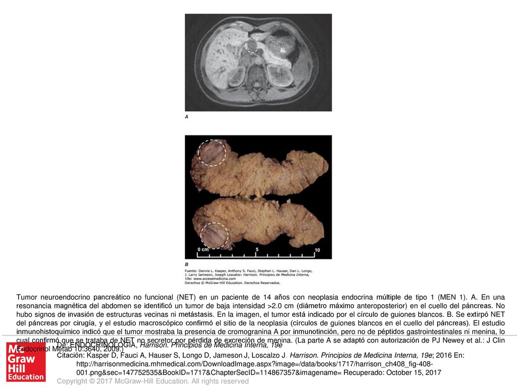 Tumor neuroendocrino pancreático no funcional (NET) en un paciente de 14 años con neoplasia endocrina múltiple de tipo 1 (MEN 1). A. En una resonancia magnética del abdomen se identificó un tumor de baja intensidad >2.0 cm (diámetro máximo anteroposterior) en el cuello del páncreas. No hubo signos de invasión de estructuras vecinas ni metástasis. En la imagen, el tumor está indicado por el círculo de guiones blancos. B. Se extirpó NET del páncreas por cirugía, y el estudio macroscópico confirmó el sitio de la neoplasia (círculos de guiones blancos en el cuello del páncreas). El estudio inmunohistoquímico indicó que el tumor mostraba la presencia de cromogranina A por inmunotinción, pero no de péptidos gastrointestinales ni menina, lo cual confirmó que se trataba de NET no secretor por pérdida de excreción de menina. (La parte A se adaptó con autorización de PJ Newey et al.: J Clin Endocrinol Metab 10:3640, 2009.)