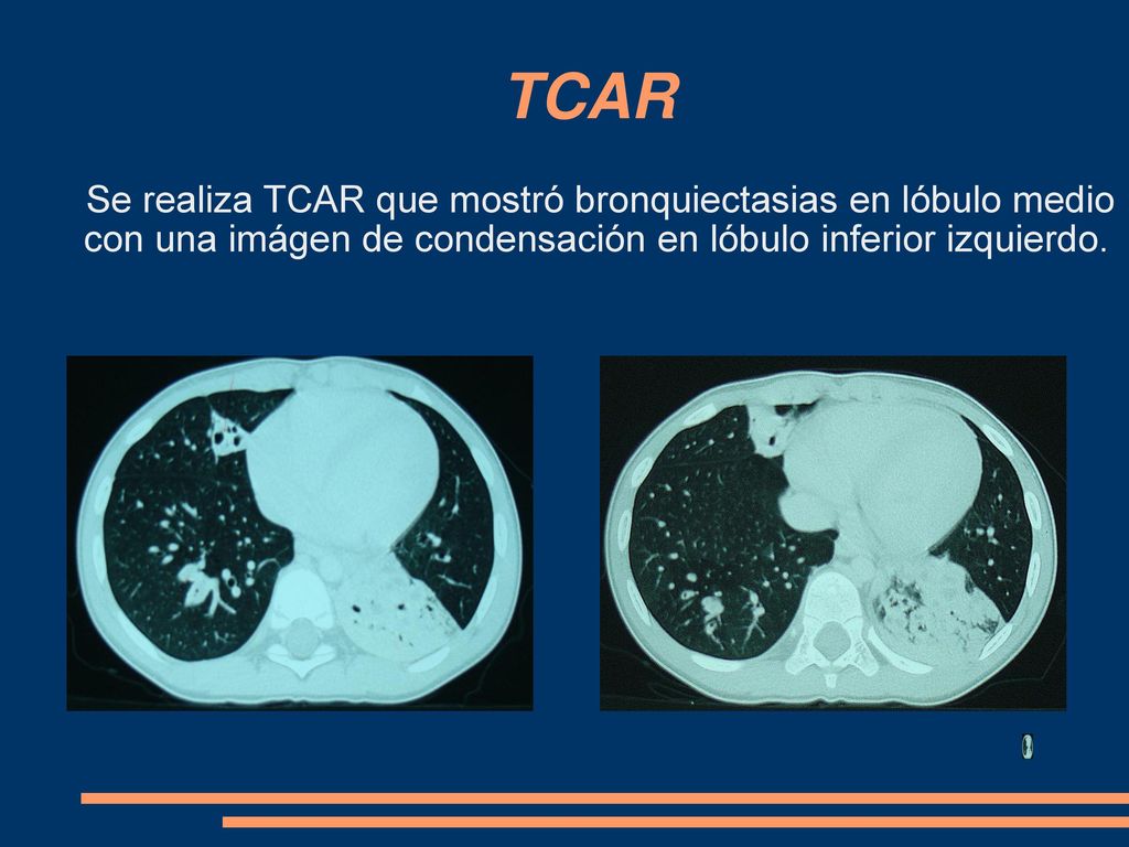 TCAR Se realiza TCAR que mostró bronquiectasias en lóbulo medio con una imágen de condensación en lóbulo inferior izquierdo.