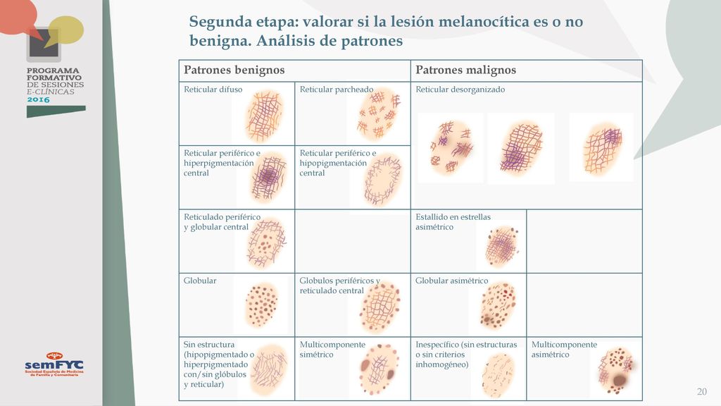 Segunda etapa: valorar si la lesión melanocítica es o no benigna