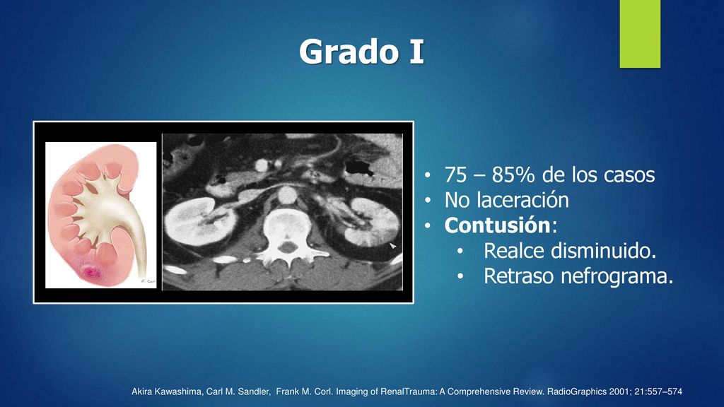 Grado I 75 – 85% de los casos No laceración Contusión: