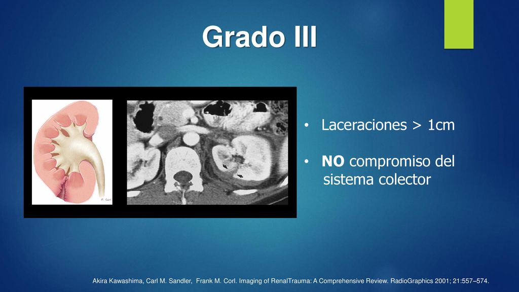 Grado III Laceraciones > 1cm NO compromiso del sistema colector