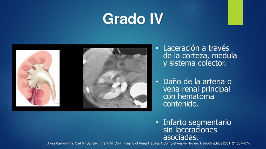 Grado IV Laceración a través de la corteza, medula y sistema colector.
