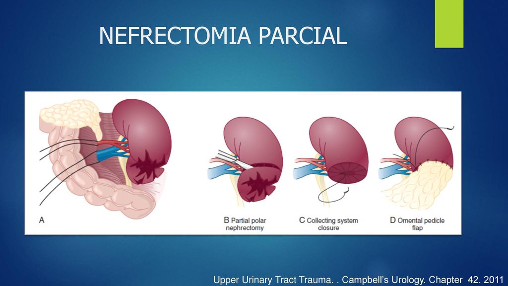 NEFRECTOMIA PARCIAL NEFRECTOMIA PARCIAL. Cuando las lesiones polares no pueden ser reconstruidos. 1. Eliminar el tejido no viable.