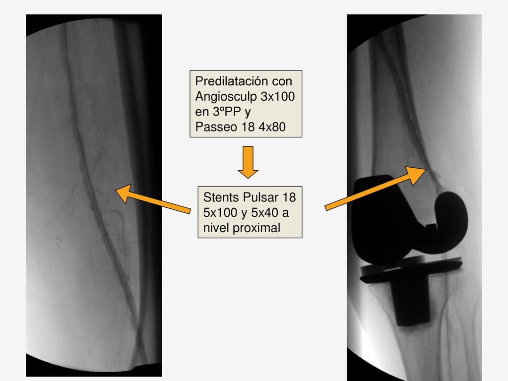 Predilatación con Angiosculp 3x100 en 3ºPP y Passeo 18 4x80