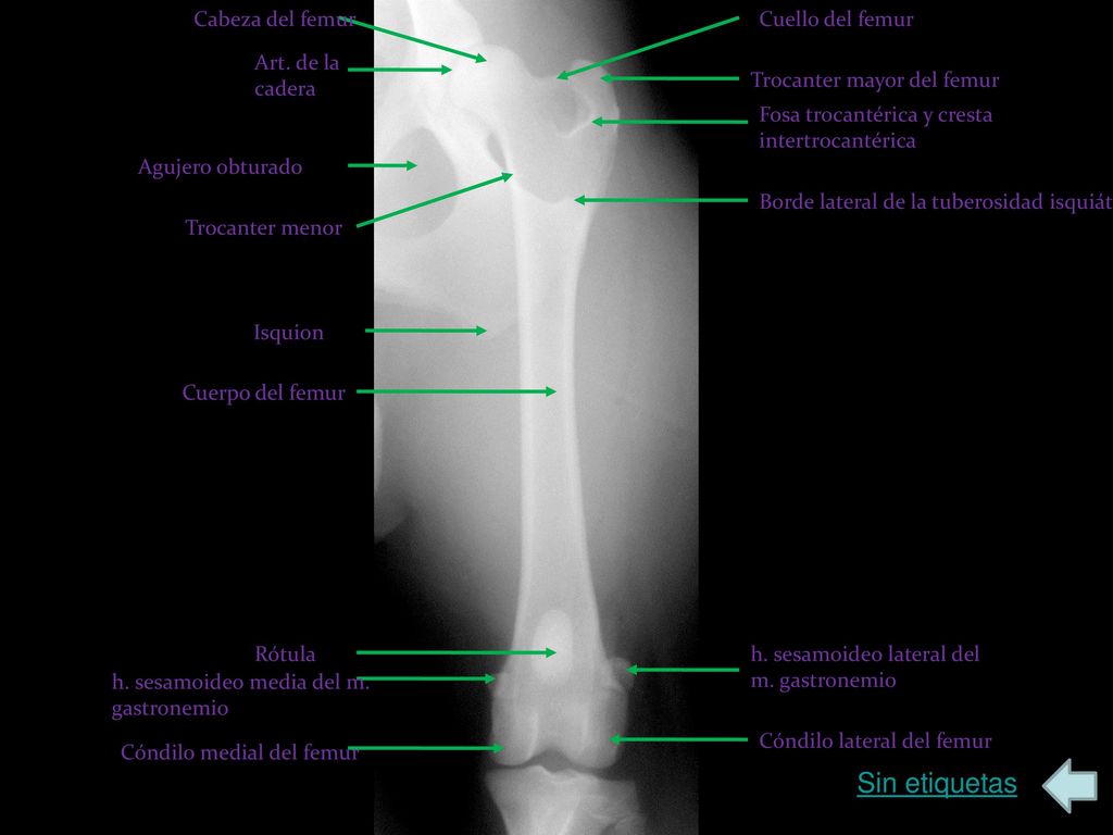 Sin etiquetas Cabeza del femur Cuello del femur Art. de la cadera
