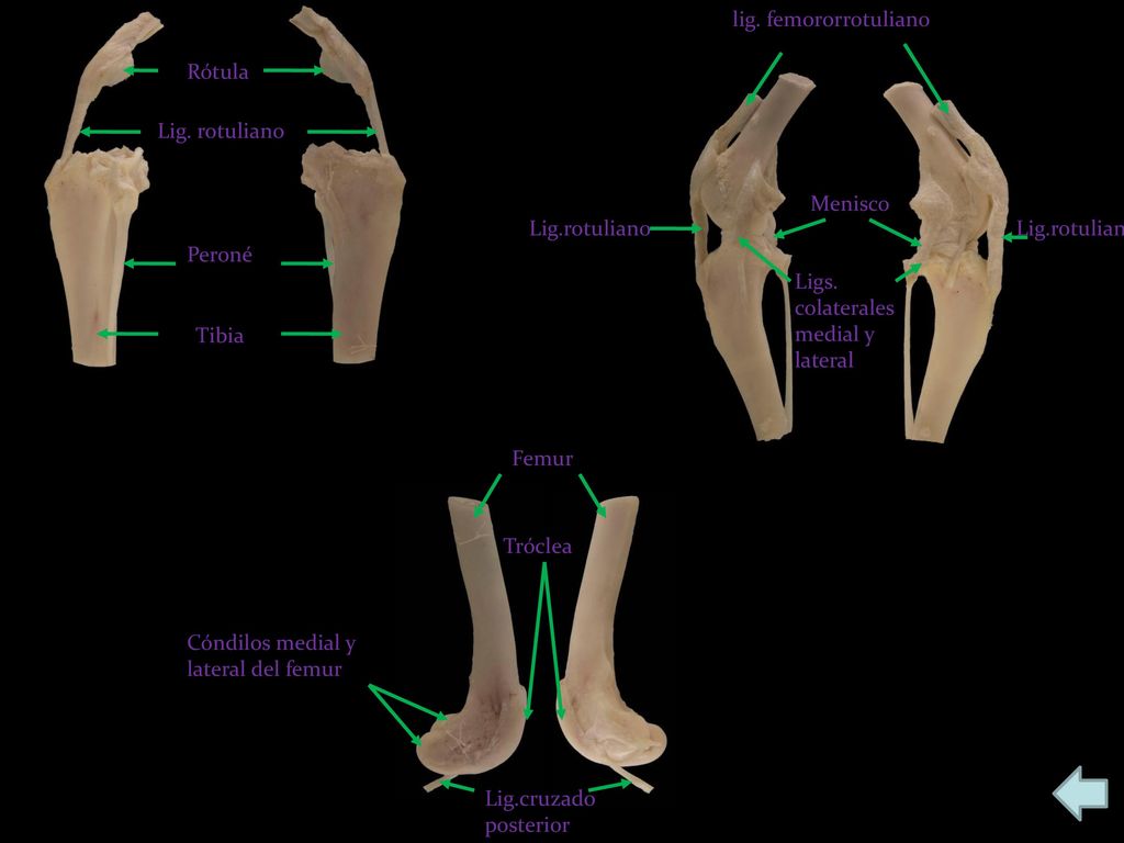 lig. femororrotuliano Rótula. Lig. rotuliano. Menisco. Lig.rotuliano. Lig.rotuliano. Peroné. Ligs. colaterales medial y lateral.