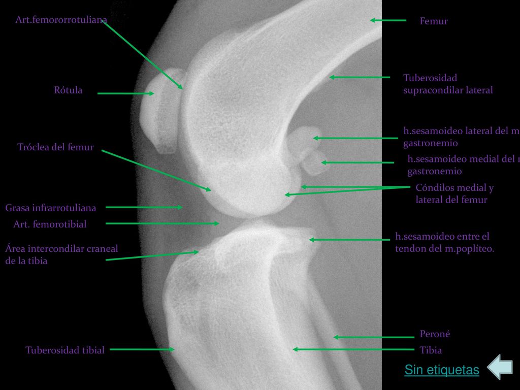 Sin etiquetas Art.femororrotuliana Femur