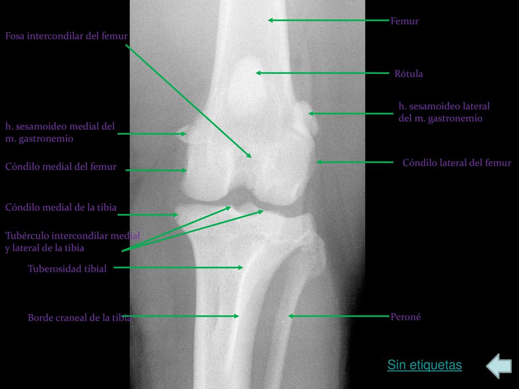 Sin etiquetas Femur Fosa intercondilar del femur Rótula